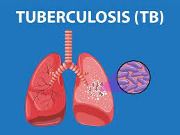 Photo of lungs with one healthy lung and one TB infected lung